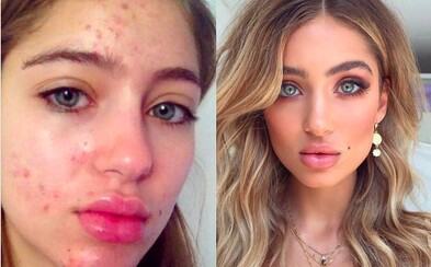 Nehanbi sa za svoje akné! #Freethepimple je novým hnutím na Instagrame Nehanbi sa za svoje akné! #Freethepimple je novým hnutím na Instagrame