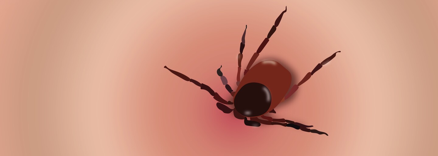 Neléčená borelióza vede k fatálním následkům. Rizikem je ale i falešná pozitivita a zbytečné nasazení antibiotik