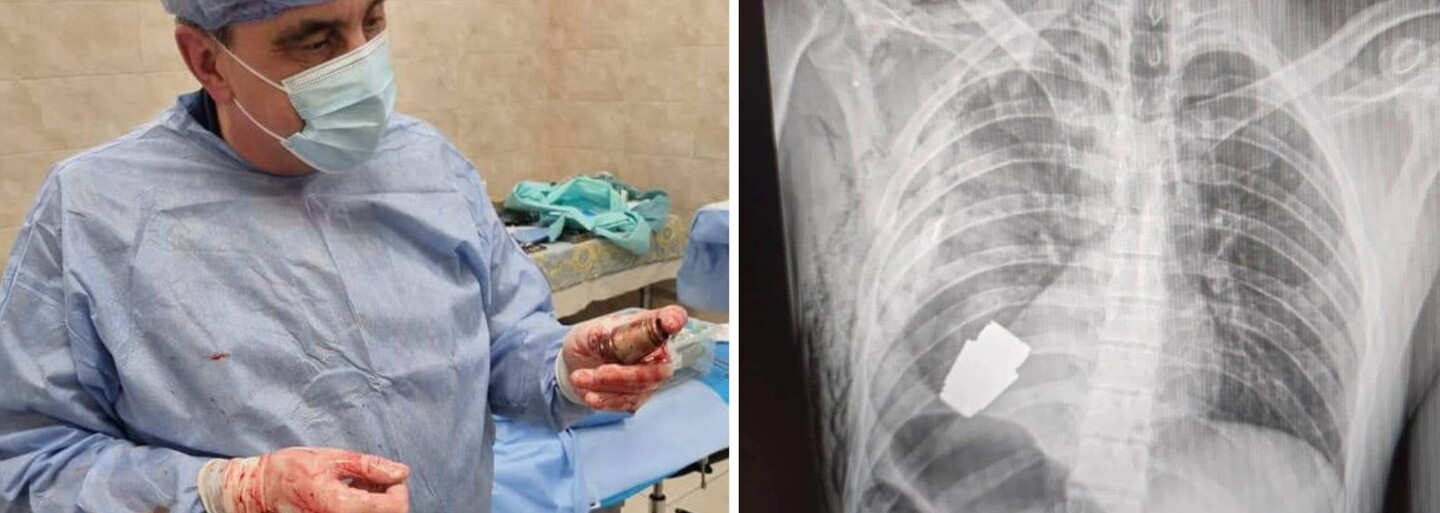 Operace, která se zapíše do učebnic medicíny: Ukrajinští chirurgové odstranili z hrudi vojáka nevybuchlý granát