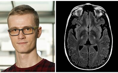 Počítač analyzujúci snímky mozgu lepšie ako skúsený lekár? Vďaka mladému slovenskému doktorandovi to môže byť onedlho realita Počítač analyzujúci snímky mozgu lepšie ako skúsený lekár? Vďaka mladému slovenskému doktorandovi to môže byť onedlho realita