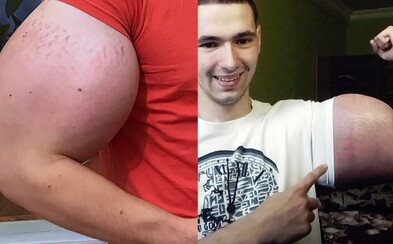 Ruského syntholového maniaka možno čaká amputácia rúk či paralýza. Lekári ho upozorňujú na nebezpečenstvo, ale on si olej pichať neprestáva Ruského syntholového maniaka možno čaká amputácia rúk či paralýza. Lekári ho upozorňujú na nebezpečenstvo, ale on si olej pichať neprestáva