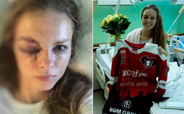 Slovenskú reportérku zasiahol do tváre puk, hrozilo, že nebude vidieť. Z nemocnice hlási, že je v poriadku