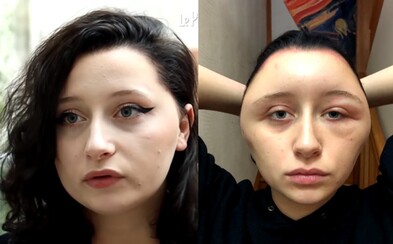 Studentce napuchla hlava po použití barvy na vlasy Studentce napuchla hlava po použití barvy na vlasy