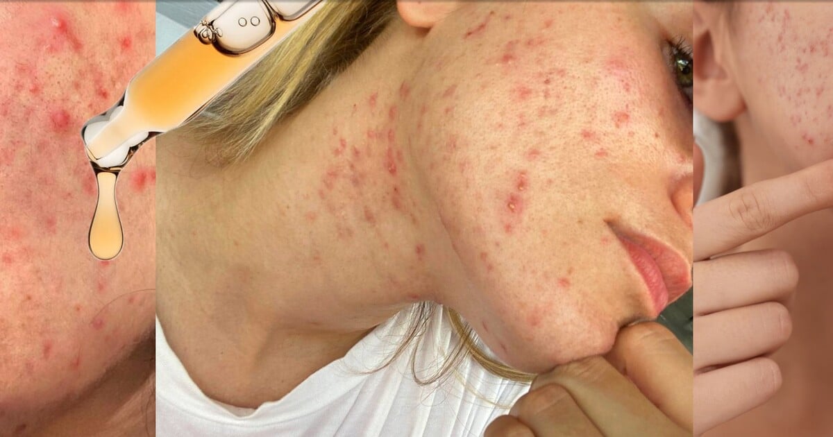 Akné v dospělosti: Proč se objevuje, jak ho řešit a kdy vyhledat odborníka*odbornici