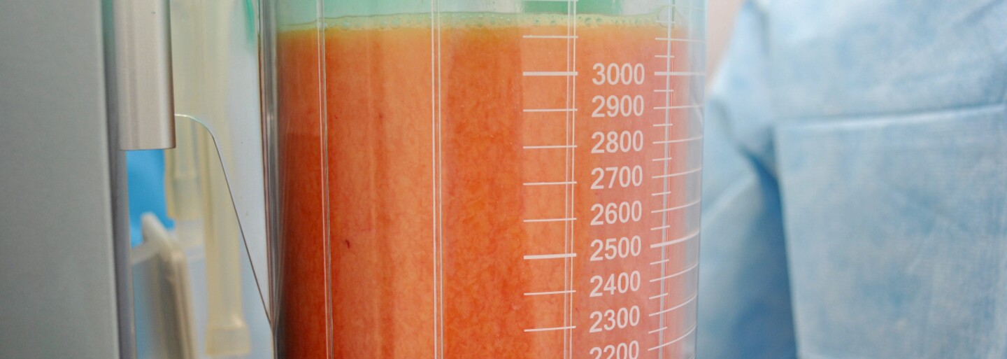 Takto vyzerá liposukcia: boli sme priamo na sále. Oplatí sa ti dať si odsať tuk?