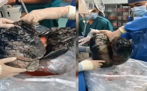 Takto vyzerajú pľúca človeka, ktorý aktívne fajčil 30 rokov. Pôvodne mali byť použité na transplantáciu, doktori to odmietli