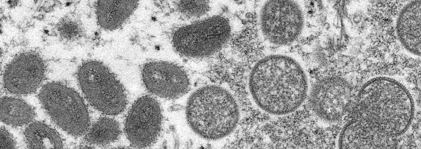 Tři diagnózy naráz: Ital měl pozitivní test na covid, opičí neštovice i HIV