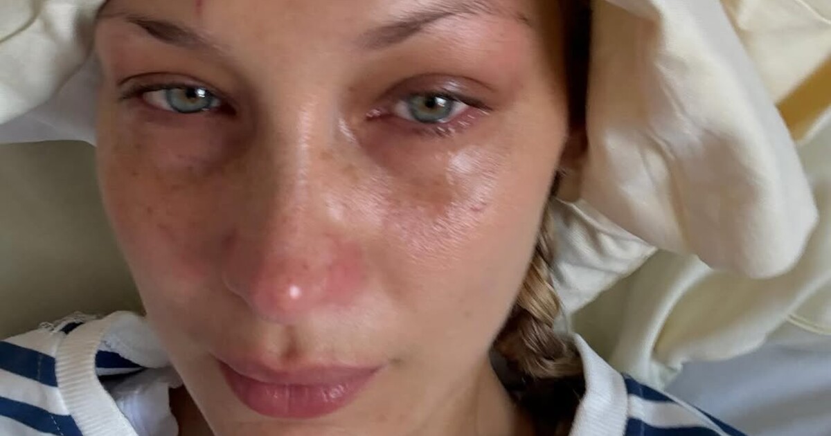 Bella Hadid sdílela fotografii z nemocničního lůžka. Trpí záhadnou nemocí