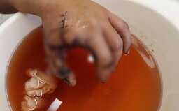 Urvaný prst, vyděšený pes, následky do konce života. Co se může stát, když se silvestr vymkne z rukou