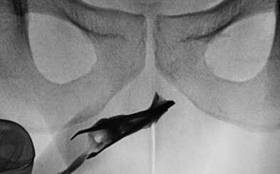 V tomto orgáne mladého muža našli lekári skoro 8-centimetrovú pinzetu. Žiadnu bolesť vraj nikdy necítil V tomto orgáne mladého muža našli lekári skoro 8-centimetrovú pinzetu. Žiadnu bolesť vraj nikdy necítil