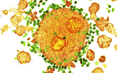Zlomový případ: Vědci vyléčili pacienta infikovaného virem HIV! Zlomový případ: Vědci vyléčili pacienta infikovaného virem HIV!