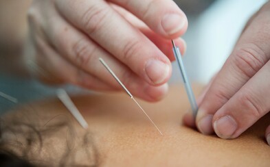 We've Tried Acupuncture. Here's a Report on How It Went, Whether It's Painful and How Much It Generally Costs. We've Tried Acupuncture. Here's a Report on How It Went, Whether It's Painful and How Much It Generally Costs.