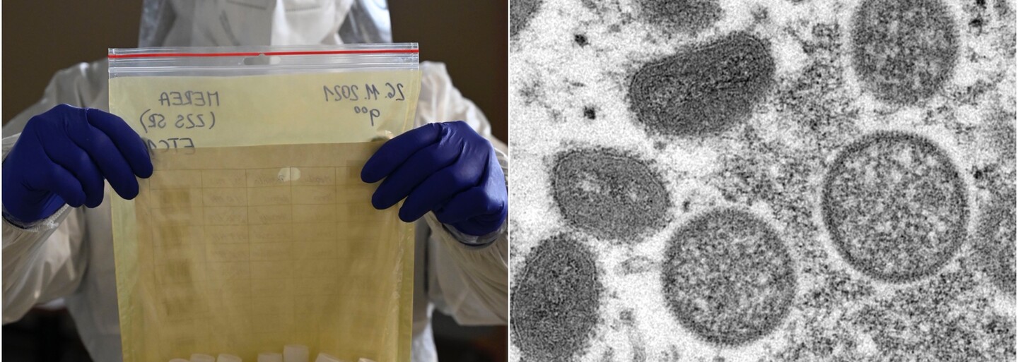 WHO přejmenuje virus opičích neštovic. Chce zabránit diskriminaci