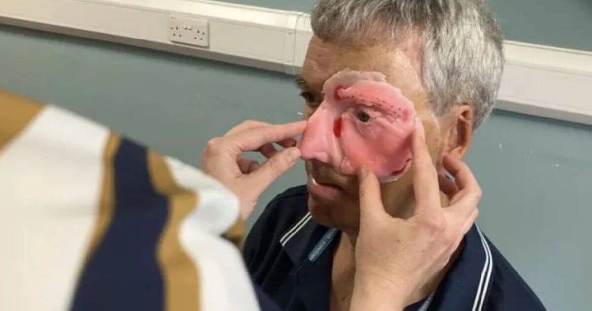 Po nehodě přišel o polovinu tváře. 3D tiskárna mu ji pomohla získat zpět