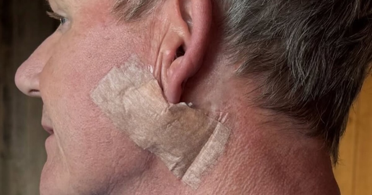 Gordon Ramsay musel kvůli rakovině kůže podstoupit zákrok. Fanouškům poslal důležitý vzkaz