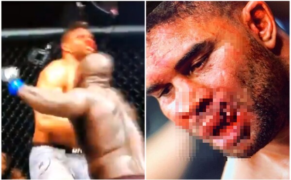 Zranenie ako z hororu: Slávny MMA bojovník dostal ranu, ktorá mu úplne roztrhala hornú peru